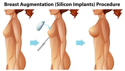 Silicone Gel Implants - Complete Guide
